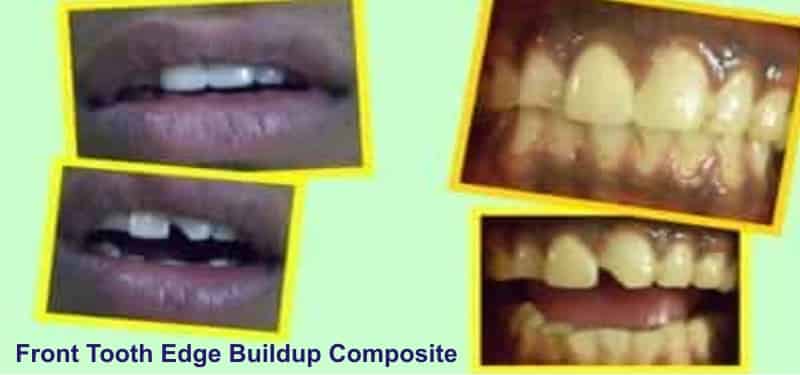 cosmetic-dentistry-front-tooth-edge-buildup-at Modern-Dental-Centre