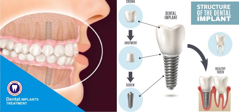 Dental Implants in Gurgaon at affordable cost