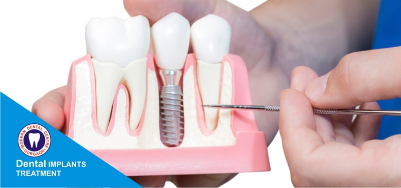 Dental-Implants-In-Gurgaon-by-Dr-Vijay-Pratap-Singh