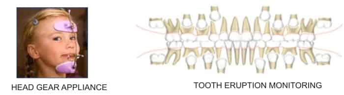 tooth-gear-appliance-and-tooth-eruption