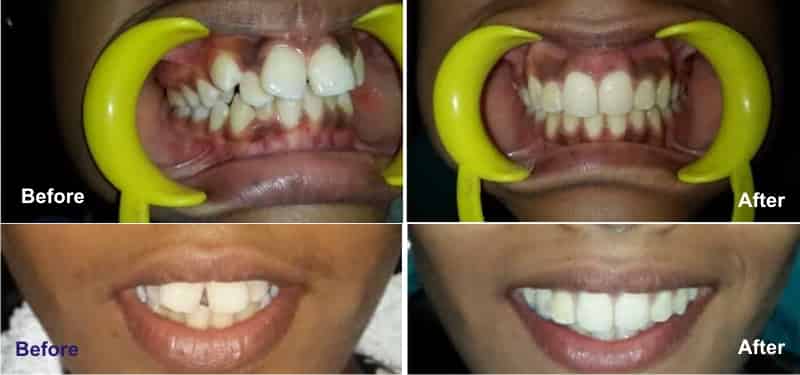 wiring-and-braces-dental-clinic-gurgaon