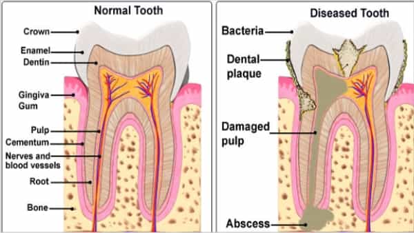 root-canal-therapy-gurgaon-endodontist-in-gurgaon