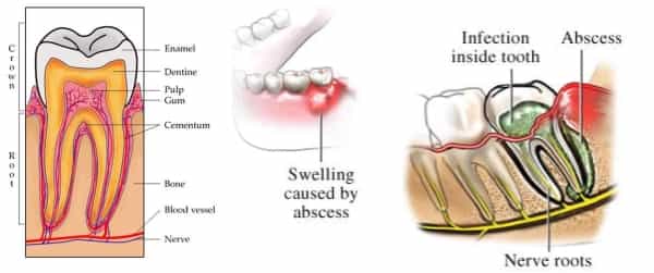 root-canal-treatment-gurgaon-symptoms-of-RCT-at Modern-Dental-Centre