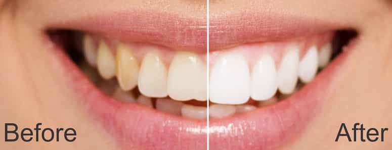 teeth-whitening-clinic in Gurgaon-modern-dental-centre