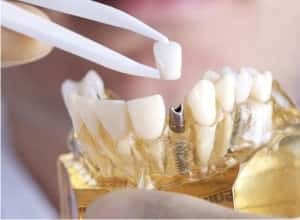 dental-implants-in-Gurgaon