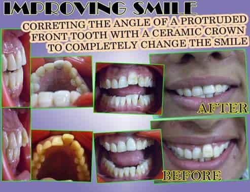 dental-smile-with-ceramic-crown-cosmetic-procedure