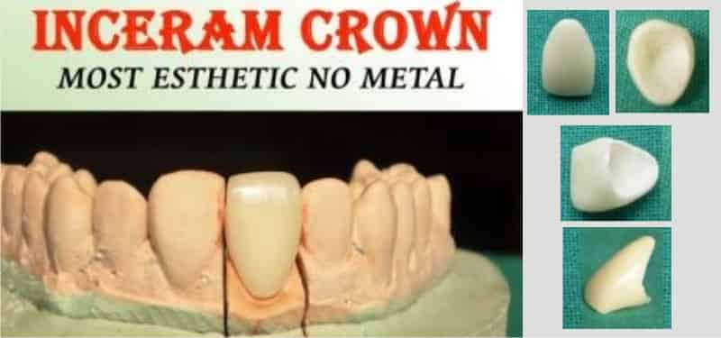 Esthetic-crowns-cosmetic-dentistry-in-Gurgaon