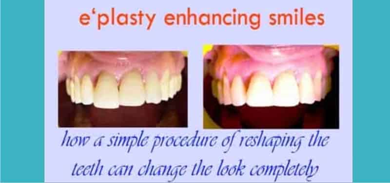 Tooth-Recontouring-Clinic-in-Gurgaon