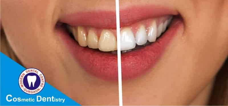 cosmetic-dentist-in-gurgaon-teeth-whitening