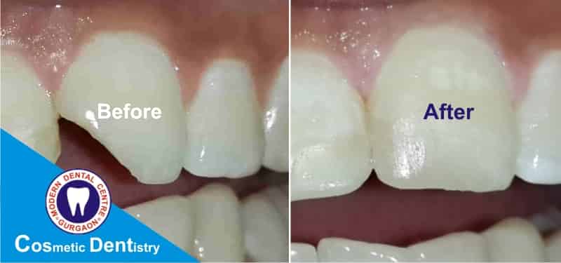 cosmetic-dentistry-in-gurgaon-by-Dr-Vijay-Pratap-Singh