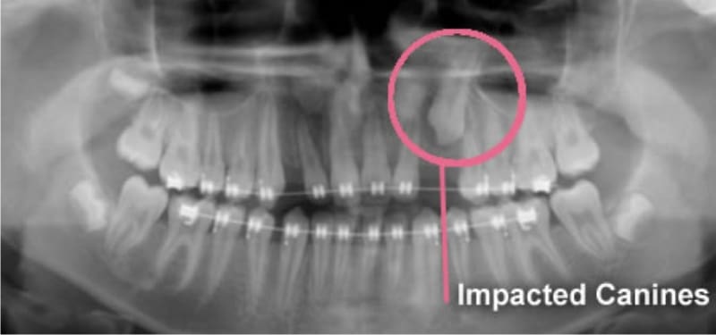 impacted-canines-oral-surgical