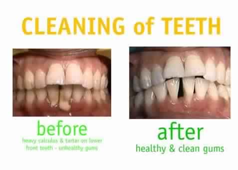 gum cleaning teeth